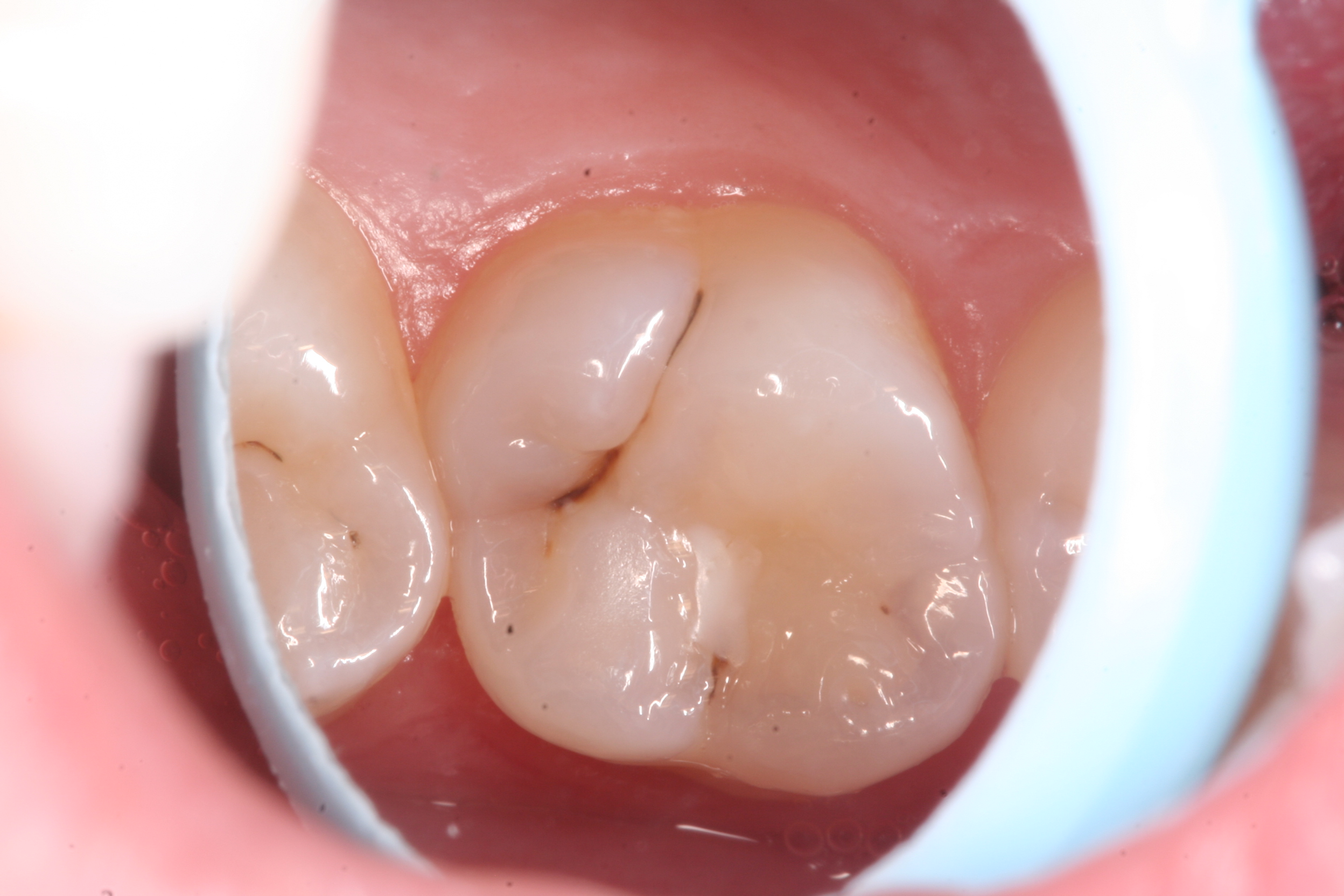 What Does A Small Tooth Cavity Look Like